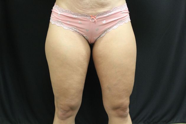 Liposuction Case 3 - Before