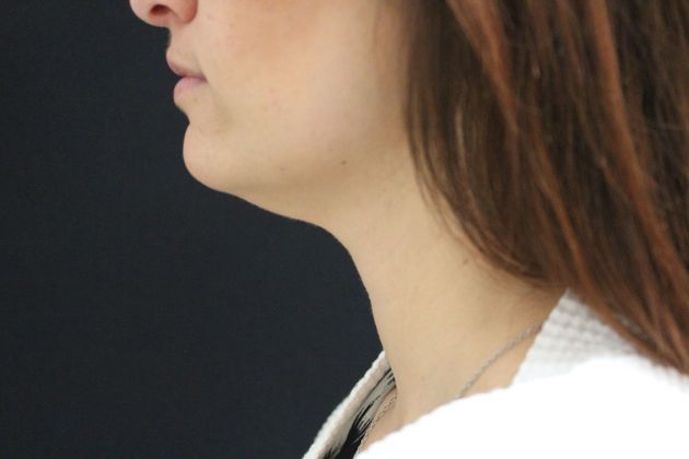 Liposuction Case 4 - Before