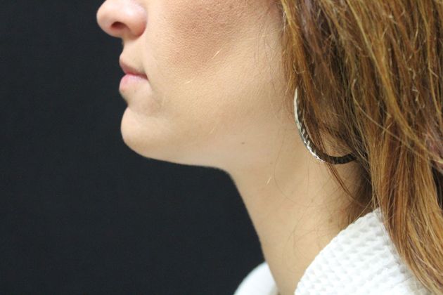 Liposuction Case 4 - After