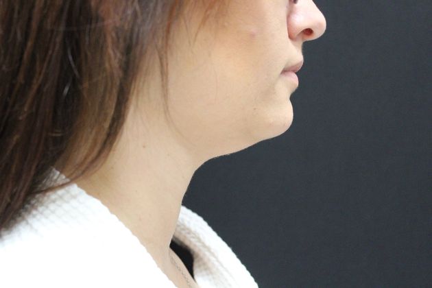 Liposuction: Case 4 - Before