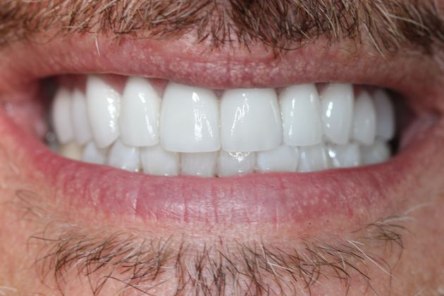 Porcelain Veneers: Case 5 - After