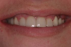 smile after a makeover