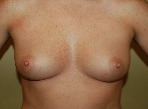Breast Augmentation Case 263 - Before