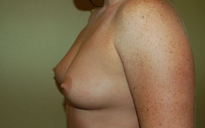 Breast Augmentation: Case 263 - Before