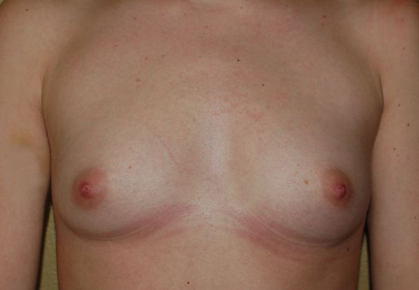 Breast Augmentation Case 271 - Before