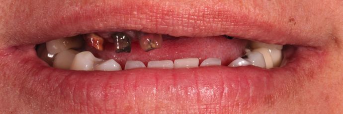 Full Mouth Dental Implant Rehabilitation UPPER ZIRCONIA DENTAL IMPLANT REHABILITATION - Before