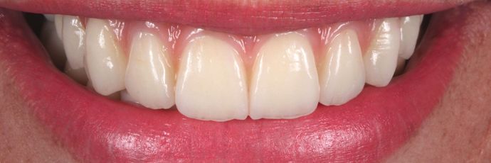 Full Mouth Dental Implant Rehabilitation UPPER ZIRCONIA DENTAL IMPLANT REHABILITATION - After