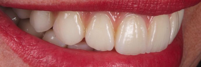 Full Mouth Dental Implant Rehabilitation: UPPER ZIRCONIA DENTAL IMPLANT REHABILITATION