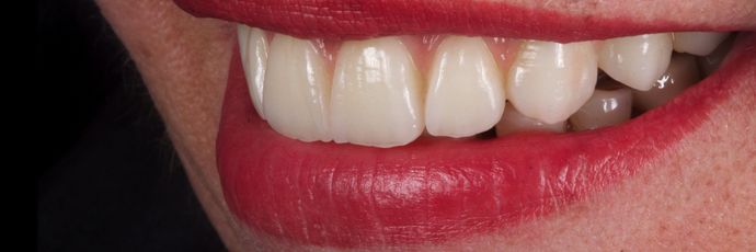 Full Mouth Dental Implant Rehabilitation: UPPER ZIRCONIA DENTAL IMPLANT REHABILITATION