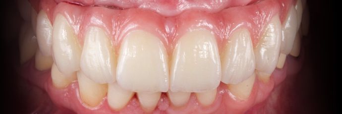 Full Mouth Dental Implant Rehabilitation: UPPER ZIRCONIA DENTAL IMPLANT REHABILITATION