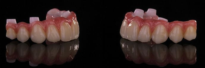 Full Mouth Dental Implant Rehabilitation: UPPER ZIRCONIA DENTAL IMPLANT REHABILITATION