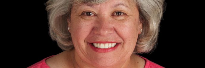 Full Mouth Dental Implant Rehabilitation: UPPER ZIRCONIA DENTAL IMPLANT REHABILITATION