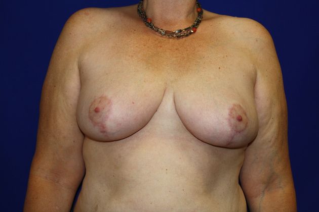 Breast Reduction Case 6 - After