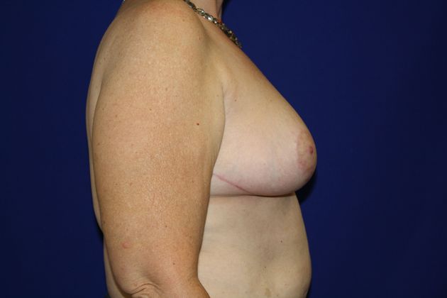 Breast Reduction: Case 6 - After
