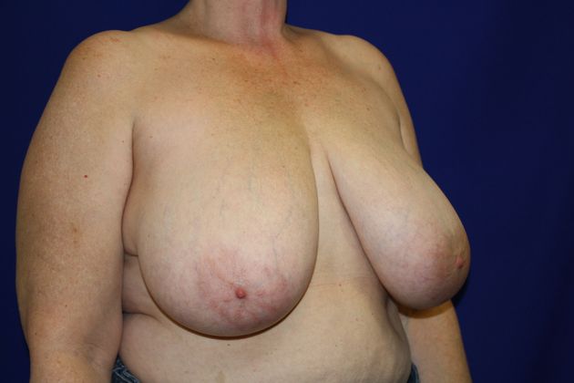 Breast Reduction: Case 6 - Before