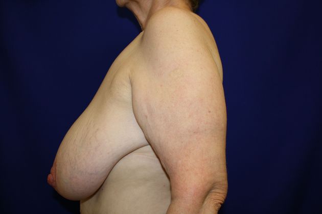 Breast Reduction: Case 7 - Before