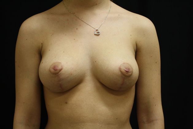 Breast Reduction Case 8 - After