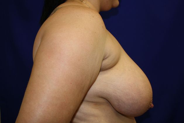 Breast Reduction: Case 9 - Before