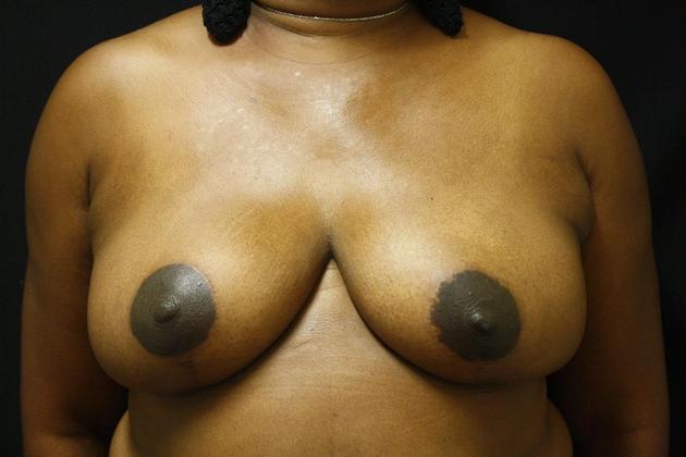Breast Reduction Case 10 - After