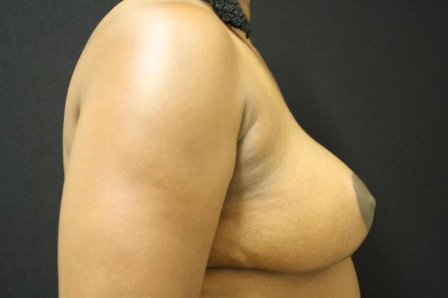 Breast Reduction: Case 10 - After
