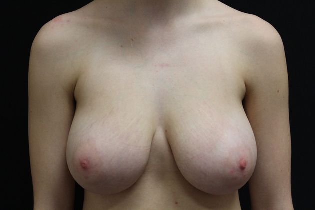 Breast Reduction Case 13 - Before
