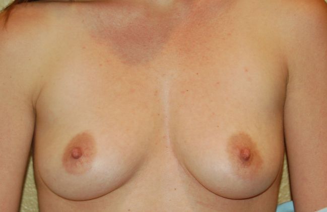 Breast Augmentation Case 273 - Before