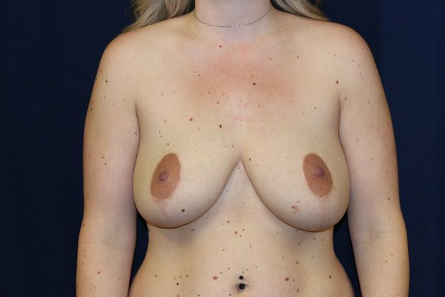 Breast Reduction*: Case 8 - Before