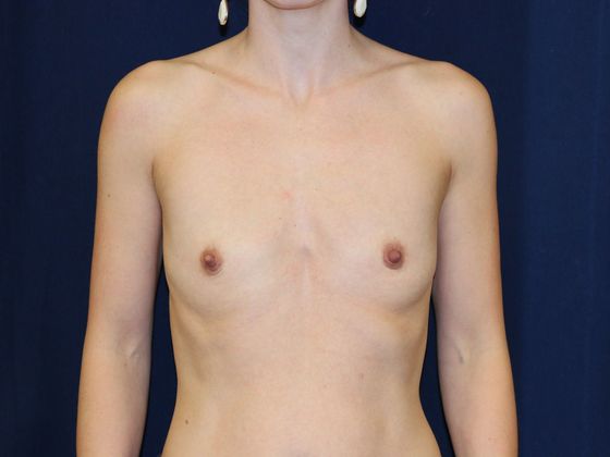 Breast Augmentation*: Case 29 - Before
