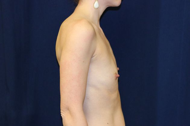 Breast Augmentation*: Case 29 - Before