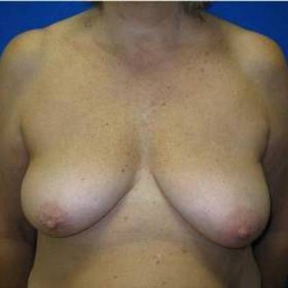 Oncoplastic Breast Reconstruction Case 1 - Before