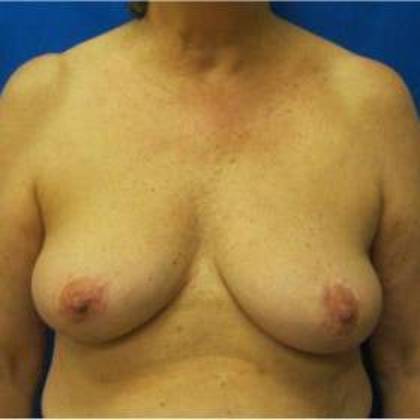 Oncoplastic Breast Reconstruction Case 1 - After