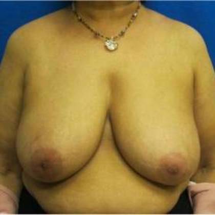Oncoplastic Breast Reconstruction: Case 2 - Before