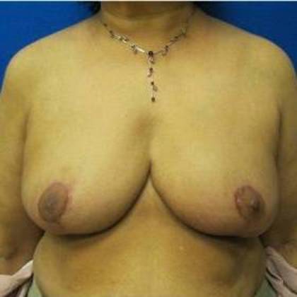 Oncoplastic Breast Reconstruction: Case 2 - After
