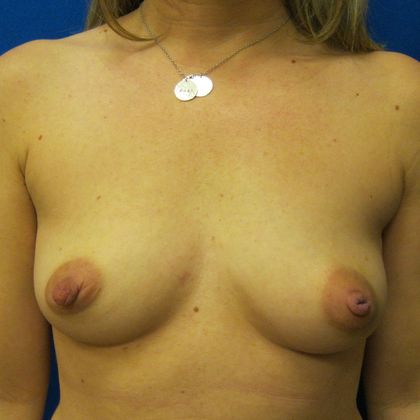 Oncoplastic Breast Reconstruction: Case 3 - Before