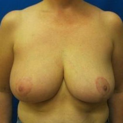 Oncoplastic Breast Reconstruction Case 4 - After