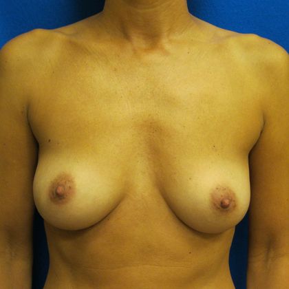 Oncoplastic Breast Reconstruction: Case 5 - Before