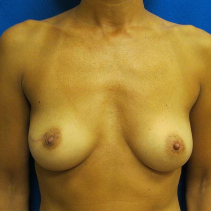 Oncoplastic Breast Reconstruction: Case 5 - After