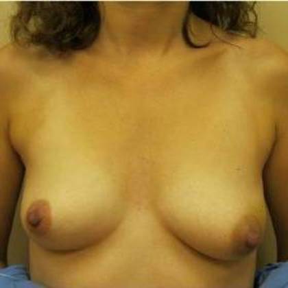 Oncoplastic Breast Reconstruction: Case 6 - Before