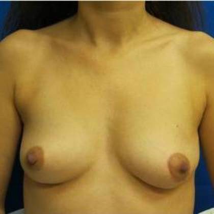 Oncoplastic Breast Reconstruction: Case 6 - After