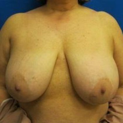 Oncoplastic Breast Reconstruction: Case 7 - Before