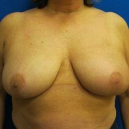 Oncoplastic Breast Reconstruction: Case 7 - After