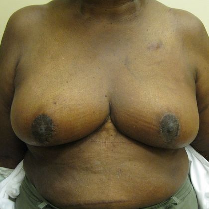 Oncoplastic Breast Reconstruction: Case 8 - After