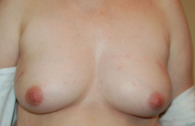 Breast Reconstruction Case 45 - Before