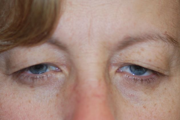 Upper Eyelid Blepharoplasty Case 39 - Before
