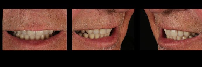 All on 4 Dental Implants: Case 13 - After All-on-4 Dental Implants