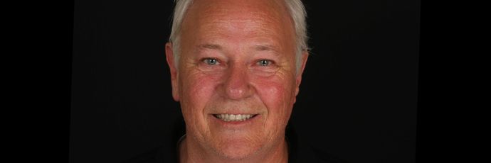 All on 4 Dental Implants Case 13