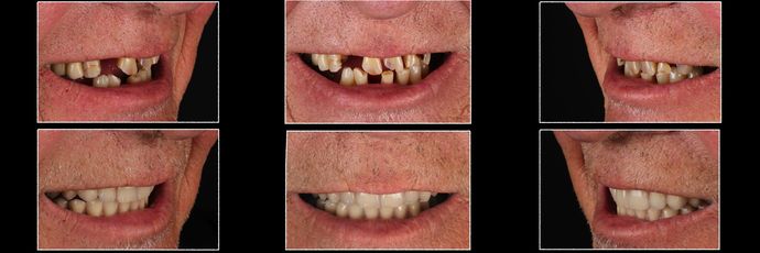 All on 4 Dental Implants: Case 13 - Before & After Comparison of  All-on-4 Dental Implants