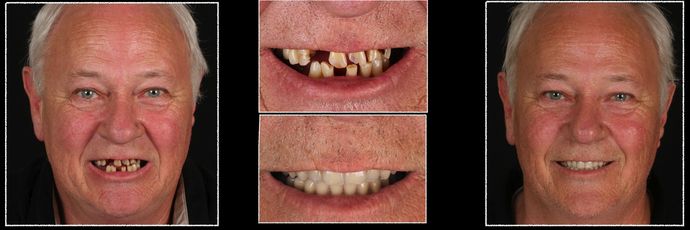 All on 4 Dental Implants: Case 13 - Before & After Comparison of  All-on-4 Dental Implants