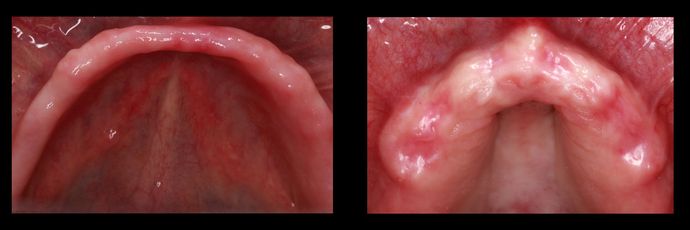All on 4 Dental Implants Case  14 - After