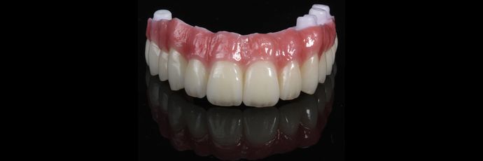 All on 4 Dental Implants: Case  14 - Zirconia Bridge